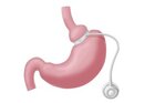How Long Does a Gastric Sleeve Surgery Typically Last?