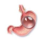 How long does a gastric balloon stay in the stomach?